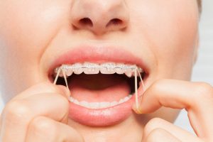 Elastics for Braces - Everything You Need to Know