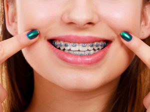 How to Care for Your Braces Over the Holiday Break